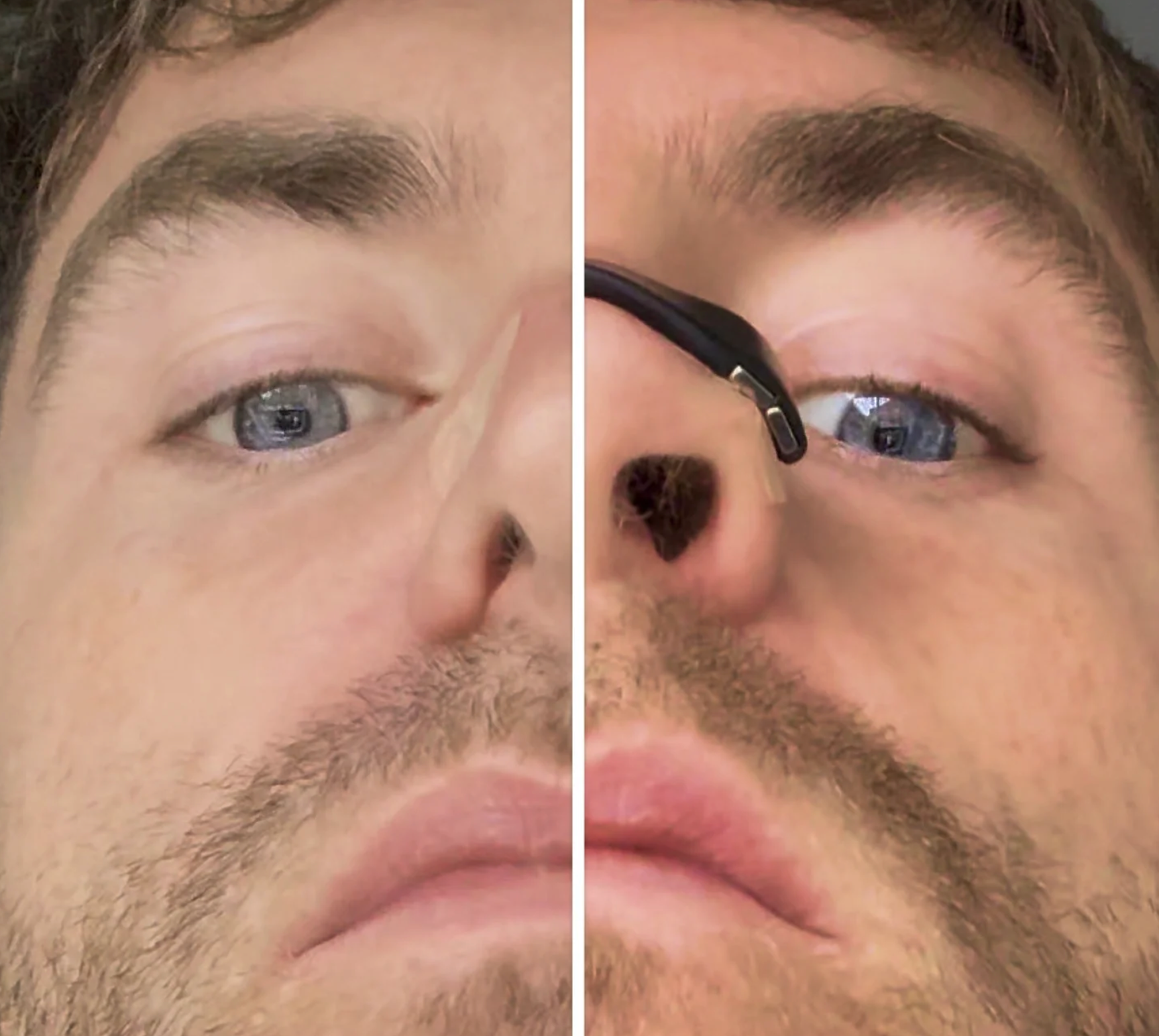 Dilatador nasal magnetico 30pcs